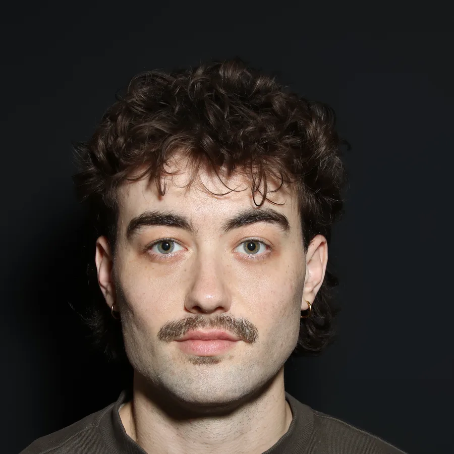 Ata, 2 weeks after jawline filler