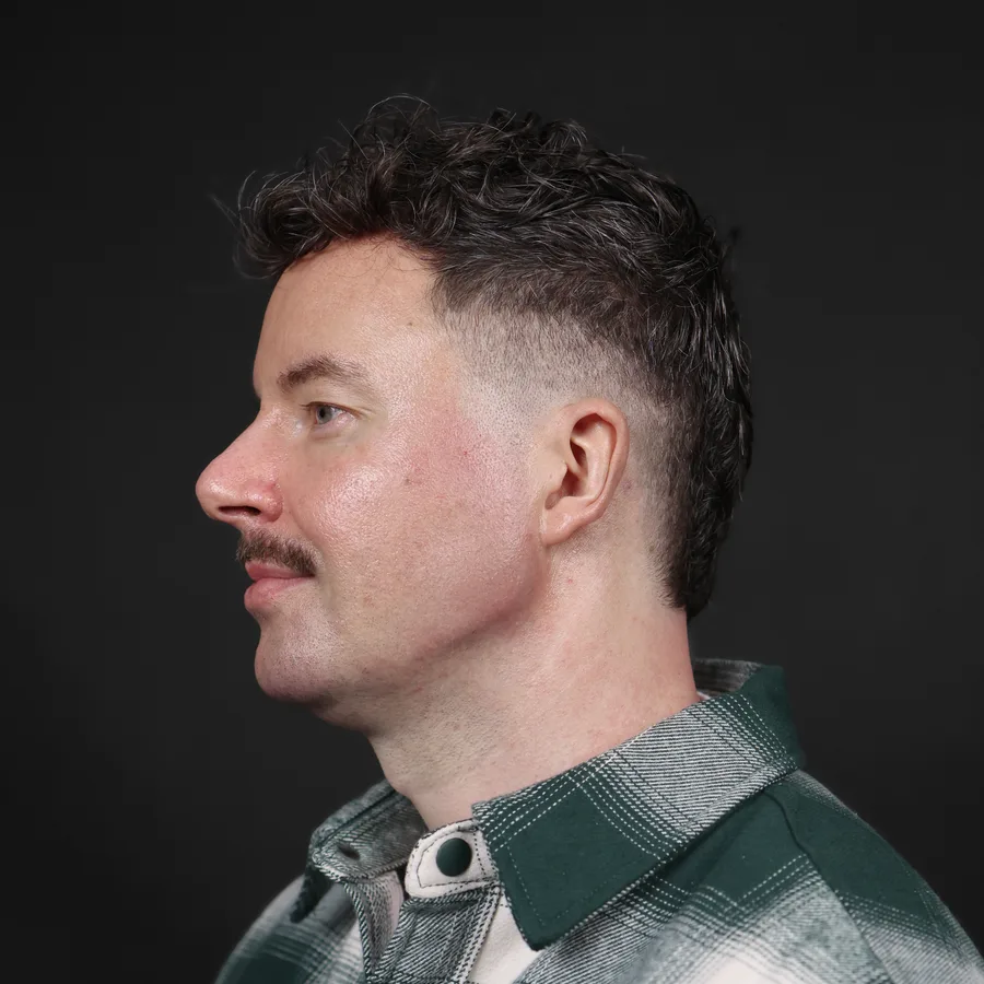 Ciaran, 2 weeks after chin filler