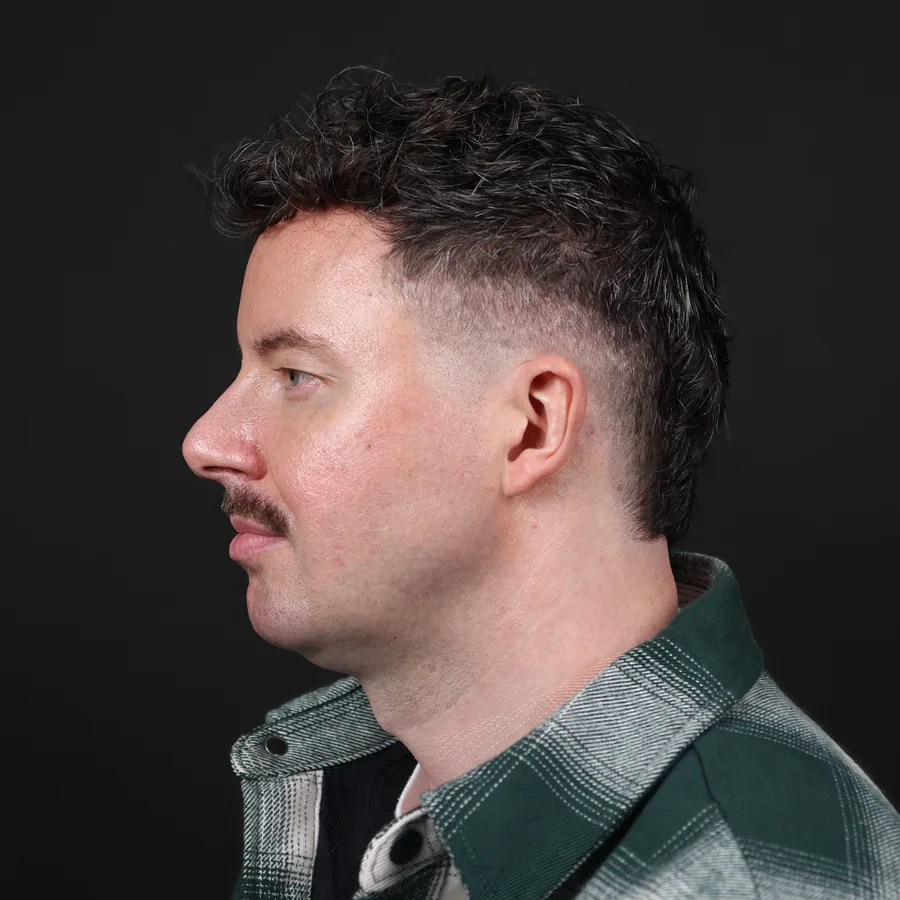 Ciaran, before chin filler