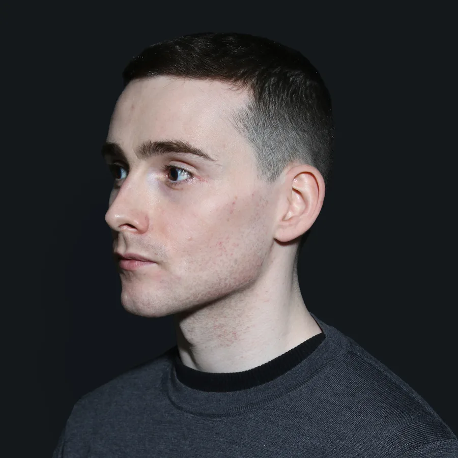 Glenn, 2 weeks after jawline filler