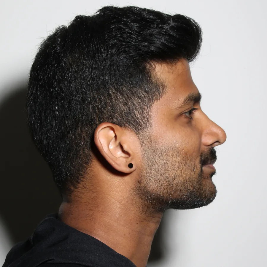 Michael, 2 weeks after jawline filler