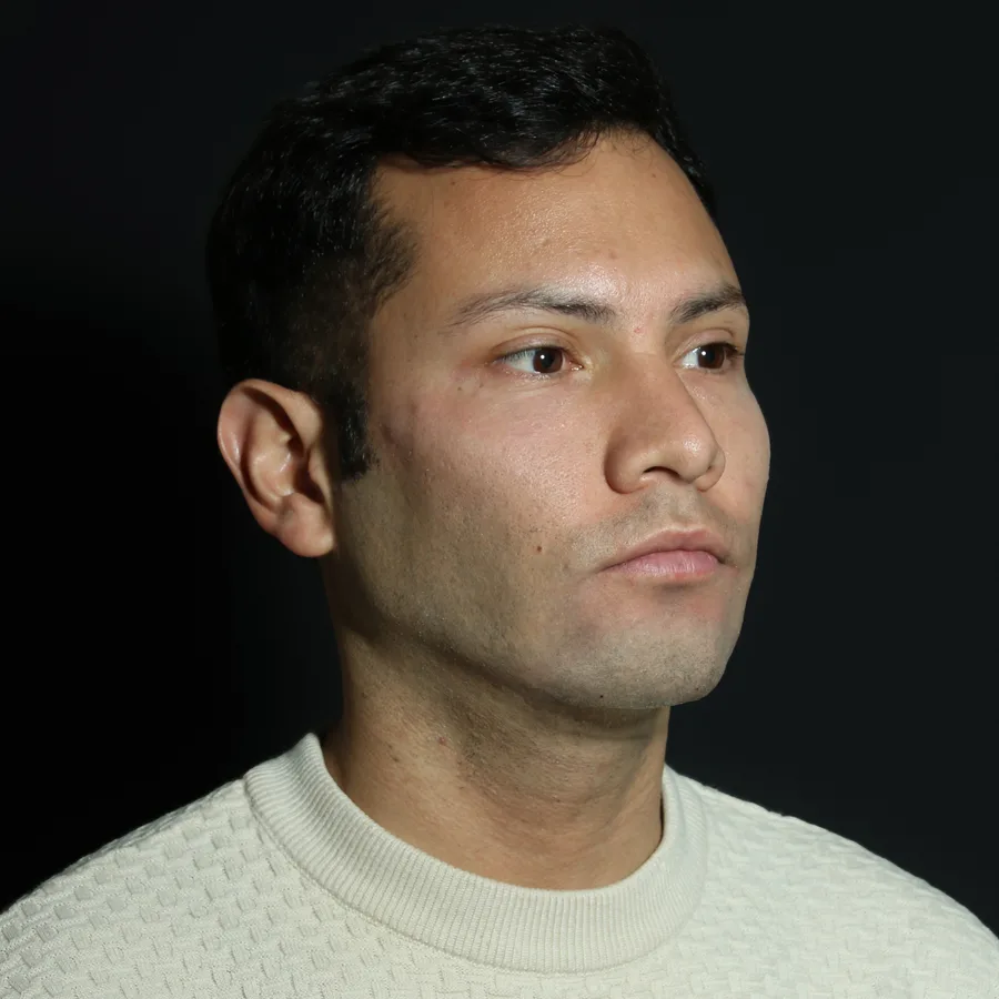 Nelson, 2 weeks after jawline filler
