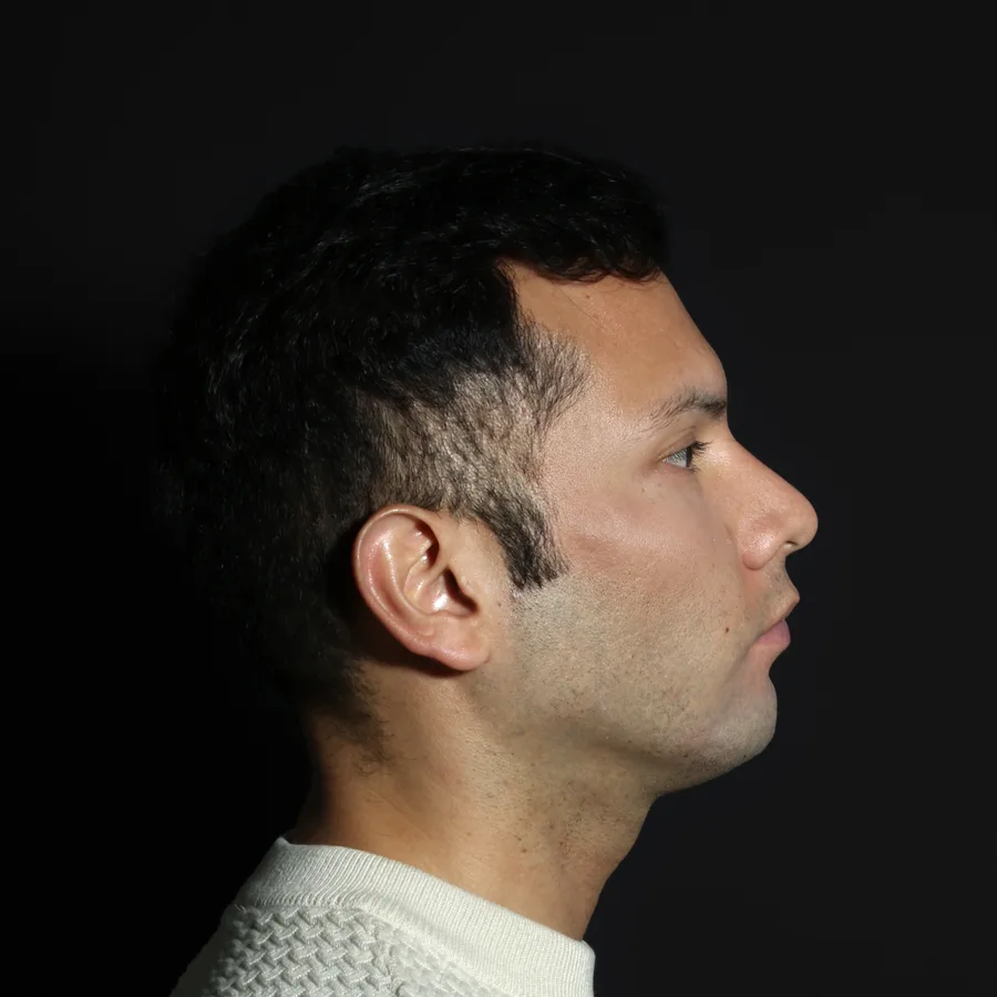 Nelson, 2 weeks after jawline filler