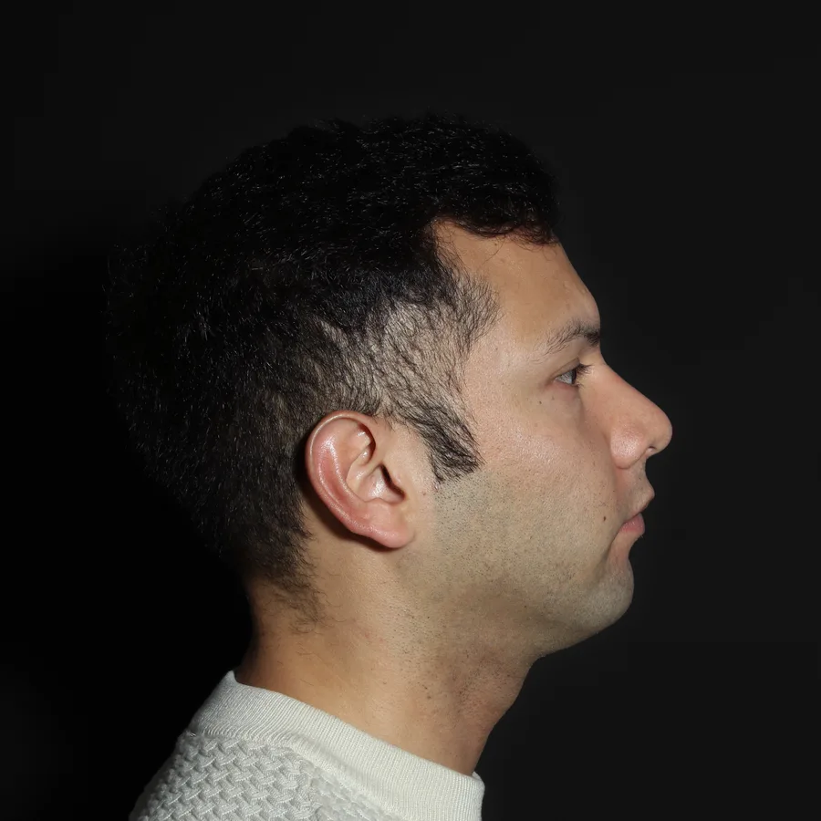 Nelson, before jawline filler